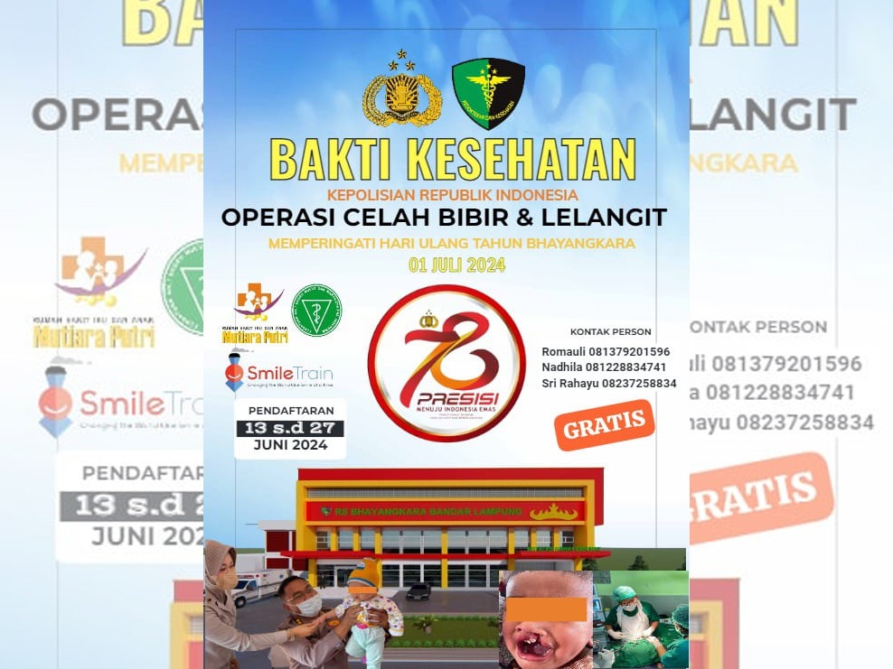 Polda Lampung Gelar Operasi Bibir Sumbing, Ini Cara Daftarnya